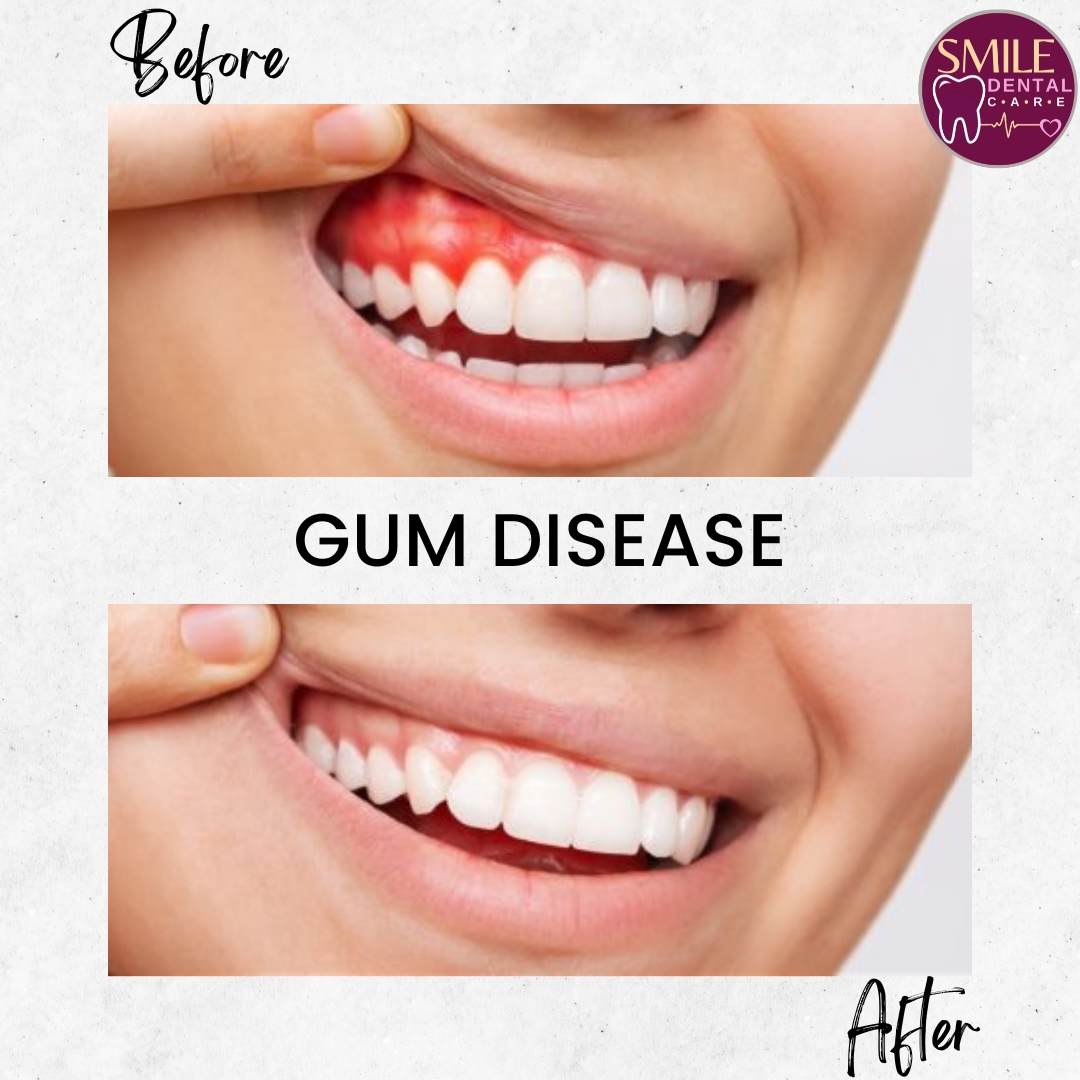 Gum Disease Before and After