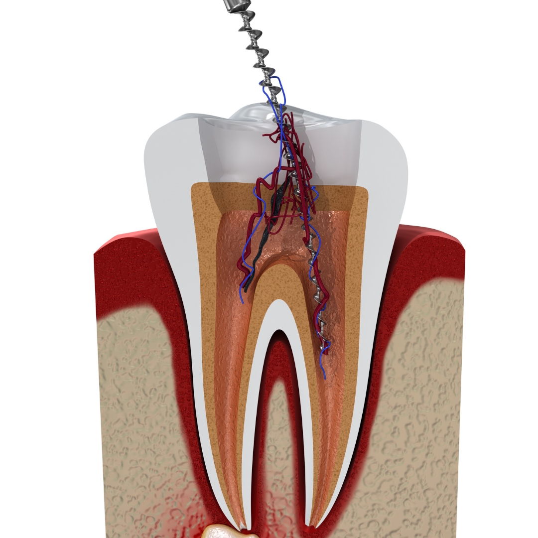 Root Canal Therapy New York